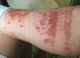 Leg rash
